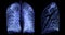 A CT chest 3D scan displaying a lesion at the right upper lobe offers a detailed visualization, aiding in precise identification