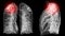 A CT chest 3D scan displaying a lesion at the right upper lobe offers a detailed visualization, aiding in precise identification