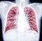 CT Chest Lung preset for detected  tuberculosis