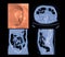 CT colonography  3D and 2D Axial,sagittal ,coronal plane .