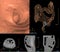 CT colonography compare 2D Axial,sagittal ,coronal plane  and 3D rendering image