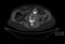 CT of contrasted aorta dissection measured