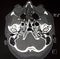 CT of cranial bones