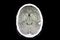 CT intracerebral hemorrhage