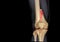 CT knee 3D rendering image AP view isolated on black background showing fracture Femur bone