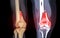 CT knee joint 3D rendering image Front view and Coronal view isolated on black background showing fracture Femur bone