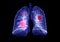 CT lung 3d rendering image with covid-19.