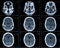 CT photography of human brain
