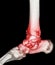 CT Scan ankle and foot or Computed Tomography of Ankle joint and Foot 3D Volume Rendering image showing fractured Tibia and fibula