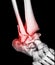 CT Scan ankle and foot or Computed Tomography of Ankle joint and Foot 3D Volume Rendering image showing fractured Tibia and fibula