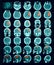 CT scan of the brain. Hemorrhagic stroke.