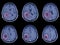 CT-Scan Brain Imaging for hemorrhagic stroke or Ischemic stroke