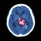 CT scan of brain : show hemorrhagic stroke