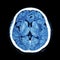 CT scan of brain : show normal human\'s brain ( CAT scan )