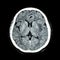 CT scan of brain : show normal human\'s brain ( CAT scan )