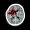 CT scan of brain : show old right basal ganglia hemorrhage with brain edema ( status post craniotomy ) ( Hemorrhagic stroke )