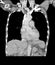 CT-Scan Chest finding Interstitial pulmonary infiltration both lungs and Normal  heart size and bony thorax.Medical