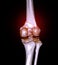 CT scan of knee joint 3D rendering image  showing fracture of distal femur bone