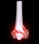CT scan of knee joint 3D rendering image  showing fracture of distal femur bone