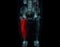 CT scan of lower extremity  ,3D illustration of Femur bone , knee joint , leg and foot