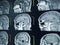 CT scan and MRI of brain : show cerebral infarct , intracerebral hemorrhage