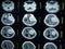 CT scan and MRI of brain : show cerebral infarct , intracerebral hemorrhage