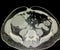 Ct scan right renal cyst  preoperative imaging