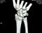 CT scan right wrist joint 3D view shows right distal radius fracture for closed reduction and cast, selective focus of a CAT scan