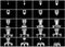 Ct scan step set of neck coronal view