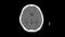 Ct scan of upper brain of head top view