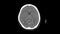 Ct scan of upper brain of head top view