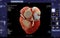 CTA Coronary artery  3D rendering image for finding coronary artery disease