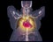 CTA Coronary artery with cta chest showing cardiovascilar system
