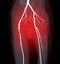 CTA femoral artery run off image of femoral artery