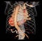 CTA thoracic aorta 3D rendering image .