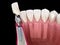 Custom abutment, dental implant and ceramic crown. Medically accurate tooth 3D illustration