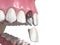 Custom abutment, dental implant and ceramic crown. Medically accurate tooth 3D illustration