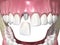 Custom abutment, dental implant and ceramic crown. Medically accurate tooth 3D illustration