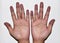 Cyanotic hands or peripheral cyanosis or blue hands at Asian young woman with congenital heart disease