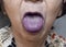 Cyanotic lips or central cyanosis at Asian, Chinese old woman