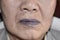 Cyanotic lips or central cyanosis at Southeast Asian old man