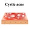 Cyst acne. Acne on the skin of a cyst. Dermatological and cosmetic diseases on the skin of the face. Infographics