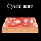 Cyst acne. Acne on the skin of a cyst. Dermatological and cosmetic diseases on the skin of the face. Infographics