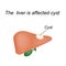 A cyst in the liver. The liver is affected cyst