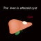 A cyst in the liver. The liver is affected cyst. Vector illustration on a black background