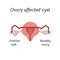 A cyst in the ovary. Pelvic organs. Vector