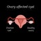 A cyst in the ovary. Pelvic organs. Vector