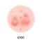 Cyst skin acne type vector icon. Skin disease acne cyst pimples type and face pore comedones