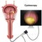 Cystoscopy of the bladder 3d  illustration on white background