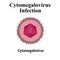 Cytamegalovirus structure. Viral infection cytomegalovirus. Sexually transmitted diseases. Infographics. Vector